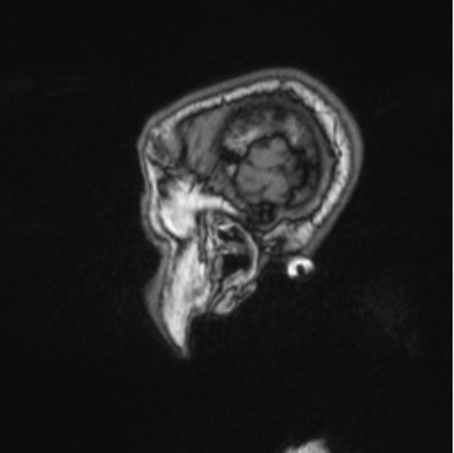 Cerebellar metastasis from lung adenocarcinoma (Radiopaedia 86690-102829 Sagittal T1 18).png