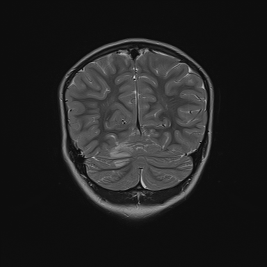 File:Cerebellar stroke (Radiopaedia 32202-33150 Coronal T2 25).png