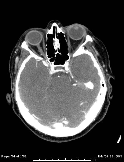 Cerebellar strokes due to intracranial giant cell arteritis (Radiopaedia 68799-78510 CT angiogram 54).jpg