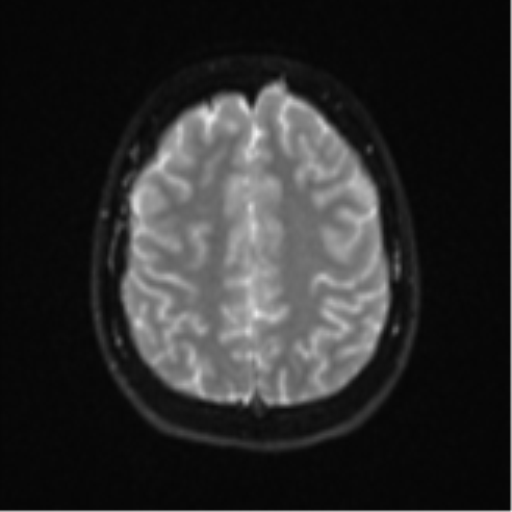 Cerebellar tuberculomas (Radiopaedia 46939-51472 Axial DWI 22).png