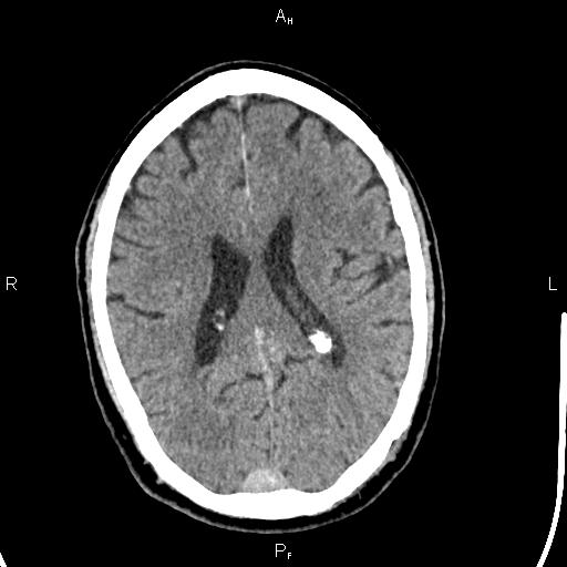 Cerebellopontine angle arachnoid cyst (Radiopaedia 85149-100704 Axial With contrast 30).jpg