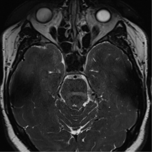Cerebellopontine angle meningioma (Radiopaedia 48434-53348 Axial T2 Space 84).png