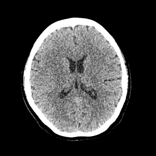 Cerebellopontine angle meningioma (Radiopaedia 53561-59592 Axial non-contrast 39).jpg