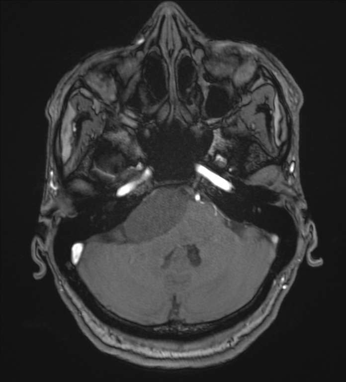 Cerebellopontine angle meningioma (Radiopaedia 72983-83680 Axial MRA 24).jpg