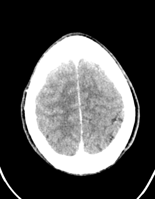 Cerebral abscess (Radiopaedia 60342-68008 Axial C+ delayed 43).png