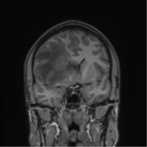 Cerebral abscess (Radiopaedia 60342-68009 Coronal T1 31).png