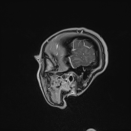 File:Cerebral abscess (Radiopaedia 60342-68009 J 50).png