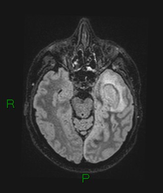 Cerebral abscess and subdural empyema (Radiopaedia 84436-99779 Axial FLAIR 54).jpg