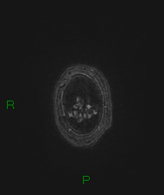 Cerebral abscess and subdural empyema (Radiopaedia 84436-99779 Axial FLAIR 8).jpg