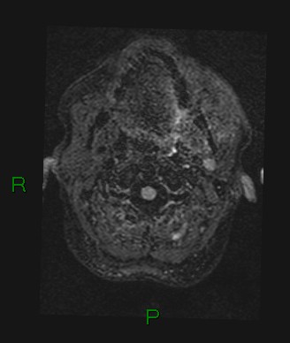 Cerebral abscess and subdural empyema (Radiopaedia 84436-99779 Axial FLAIR 82).jpg