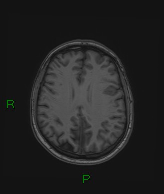 File:Cerebral abscess and subdural empyema (Radiopaedia 84436-99779 Axial T1 32).jpg