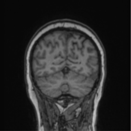 File:Cerebral abscess from pulmonary arteriovenous malformation (Radiopaedia 86275-102291 Coronal T1 23).png