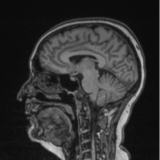 Cerebral abscess from pulmonary arteriovenous malformation (Radiopaedia 86275-102291 Sagittal T1 50).png
