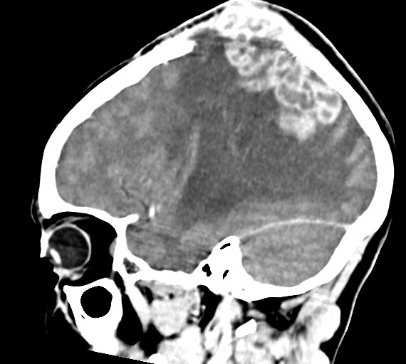 Cerebral abscesses (Radiopaedia 70458-80568 Sagittal Contrast 19).jpg