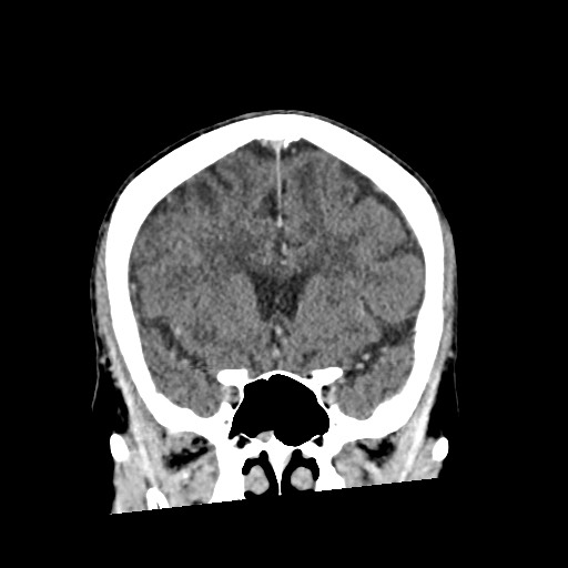 Cerebral amyloid angiopathy-related inflammation (Radiopaedia 74836-85848 Coronal non-contrast 27).jpg