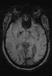 File:Cerebral amyloid angiopathy (Radiopaedia 29129-29518 Axial SWI MPR 16).jpg