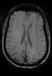 File:Cerebral amyloid angiopathy (Radiopaedia 29129-29518 Axial SWI Magnitude 22).jpg