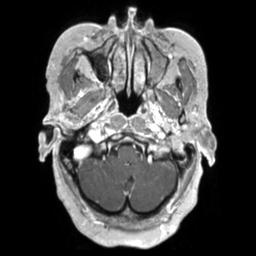 File:Cerebral amyloid angiopathy (Radiopaedia 29129-29518 Axial T1 C+ 25).jpg