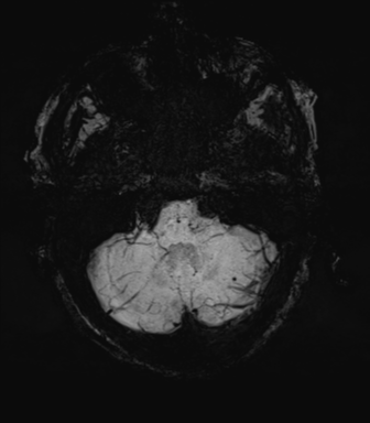 File:Cerebral amyloid angiopathy (Radiopaedia 46082-50433 Axial SWI MIP 14).png