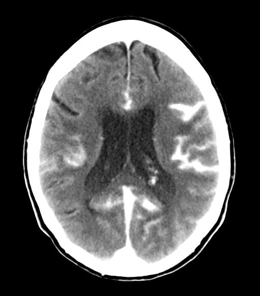 File:Cerebral aneurysm with rupture (Radiopaedia 29933-30460 Axial non-contrast 16).jpg