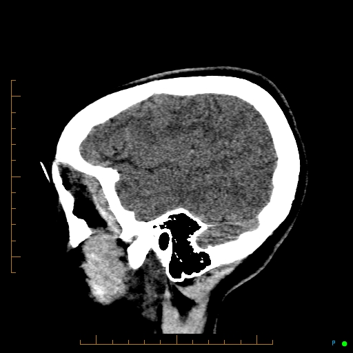 Cerebral arteriovenous malformation (AVM) (Radiopaedia 78162-90706 A 15).jpg