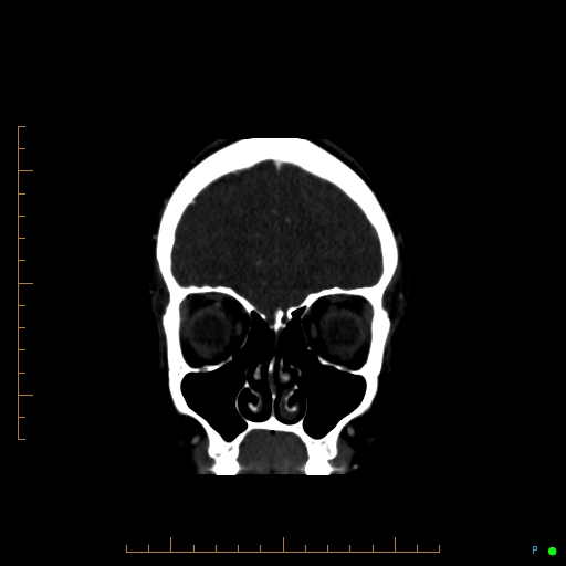 Cerebral arteriovenous malformation (AVM) (Radiopaedia 78162-90706 Coronal CTA 83).jpg