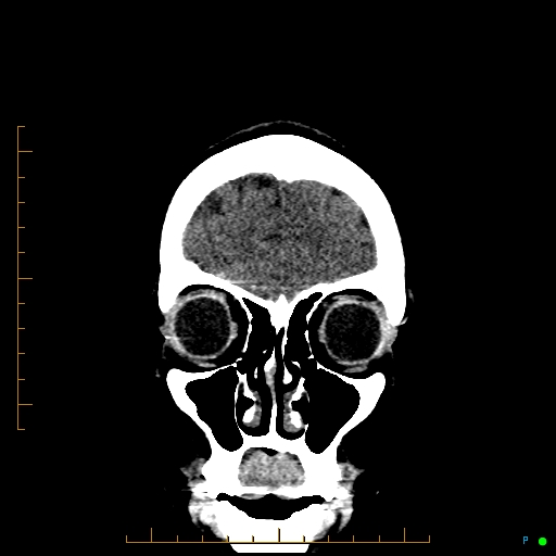 Cerebral arteriovenous malformation (AVM) (Radiopaedia 78162-90706 Coronal non-contrast 16).jpg