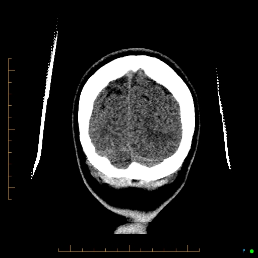 Cerebral arteriovenous malformation (AVM) (Radiopaedia 78162-90706 Coronal non-contrast 89).jpg