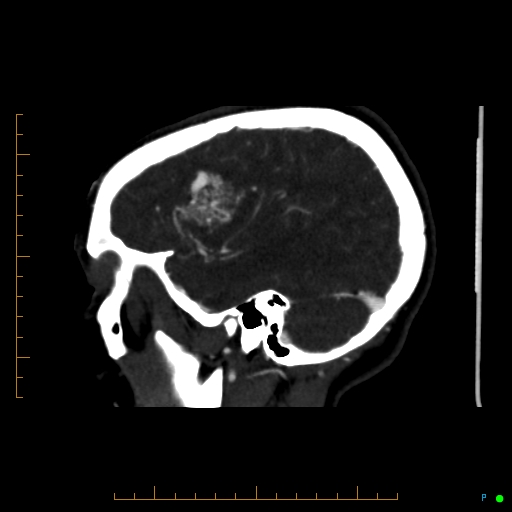 Cerebral arteriovenous malformation (AVM) (Radiopaedia 78162-90706 Sagittal CTA 20).jpg