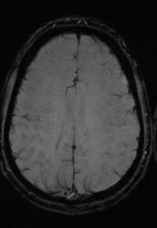 File:Cerebral arteriovenous malformation (Radiopaedia 55798-62372 Axial SWI 29).png