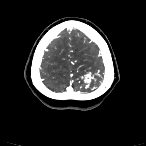 Cerebral arteriovenous malformation (Radiopaedia 73830-84645 Axial C+ delayed 10).jpg