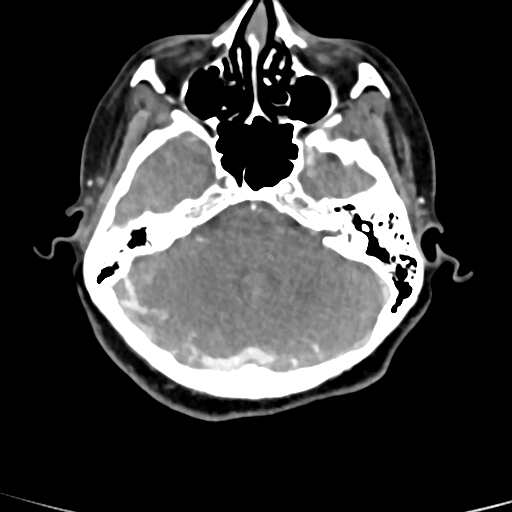 File:Cerebral arteriovenous malformation (Radiopaedia 73830-84645 B 74).jpg