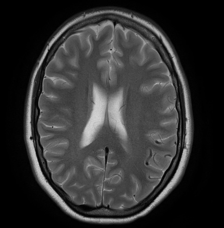 File:Cerebral arteriovenous malformation (Radiopaedia 74411-85654 Axial T2 18).jpg