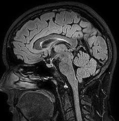Cerebral arteriovenous malformation (Radiopaedia 74411-85654 Sagittal FLAIR 60).jpg