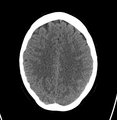 File:Cerebral arteriovenous malformation (Radiopaedia 74411-85744 Axial non-contrast 24).jpg