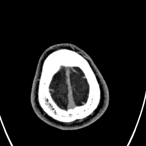 Cerebral arteriovenous malformation (Radiopaedia 78188-90746 Axial C+ delayed 161).jpg