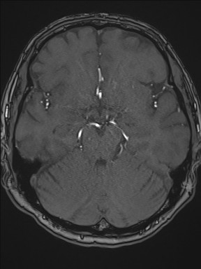File:Cerebral arteriovenous malformation (Radiopaedia 84015-99245 Axial TOF 102).jpg