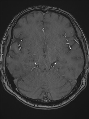 Cerebral arteriovenous malformation (Radiopaedia 84015-99245 Axial TOF 109).jpg