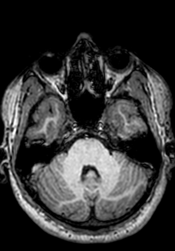 Cerebral arteriovenous malformation at posterior body of corpus callosum (Radiopaedia 74111-84925 Axial T1 233).jpg