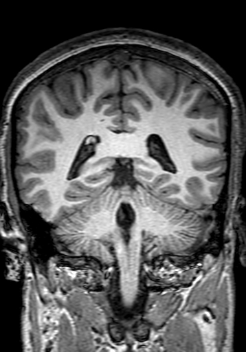 Cerebral arteriovenous malformation at posterior body of corpus callosum (Radiopaedia 74111-84925 Coronal T1 226).jpg