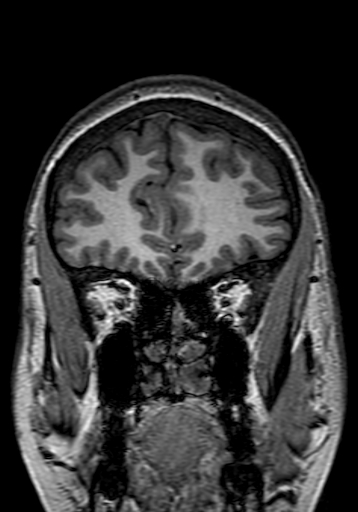 Cerebral arteriovenous malformation at posterior body of corpus callosum (Radiopaedia 74111-84925 Coronal T1 52).jpg
