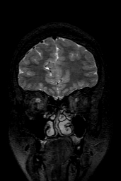 Cerebral arteriovenous malformation at posterior body of corpus callosum (Radiopaedia 74111-84925 Coronal T2 30).jpg