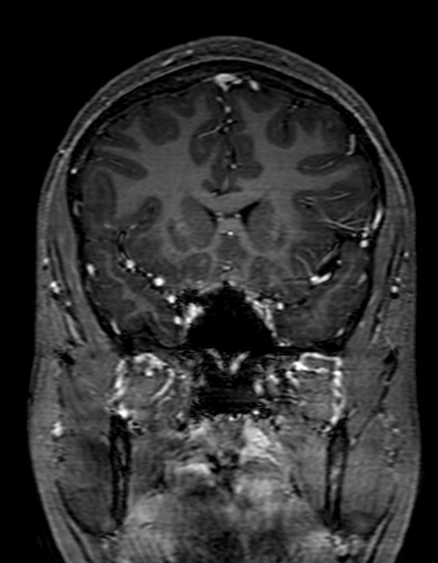 Cerebral arteriovenous malformation at posterior body of corpus callosum (Radiopaedia 74111-84925 K 123).jpg