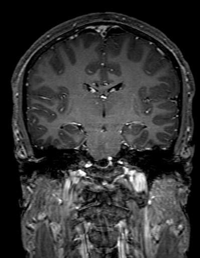 Cerebral arteriovenous malformation at posterior body of corpus callosum (Radiopaedia 74111-84925 K 196).jpg