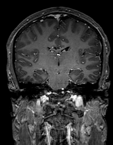 Cerebral arteriovenous malformation at posterior body of corpus callosum (Radiopaedia 74111-84925 K 199).jpg
