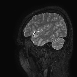 Cerebral arteriovenous malformation at posterior body of corpus callosum (Radiopaedia 74111-84925 Sagittal T2 18).jpg