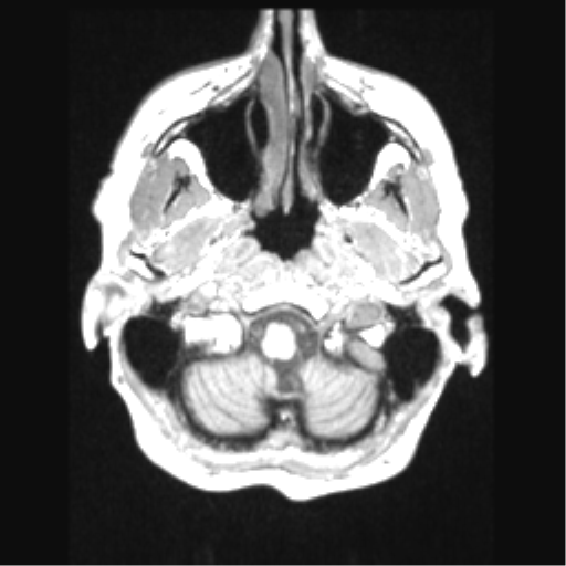 Cerebral arteriovenous malformation with hemorrhage (Radiopaedia 34422-35737 Axial T1 10).png