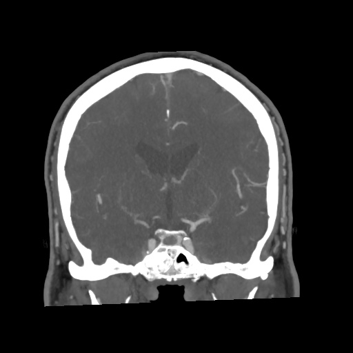 Cerebral arteriovenous malformation with lobar hemorrhage (Radiopaedia 35598-57216 C 43).jpg