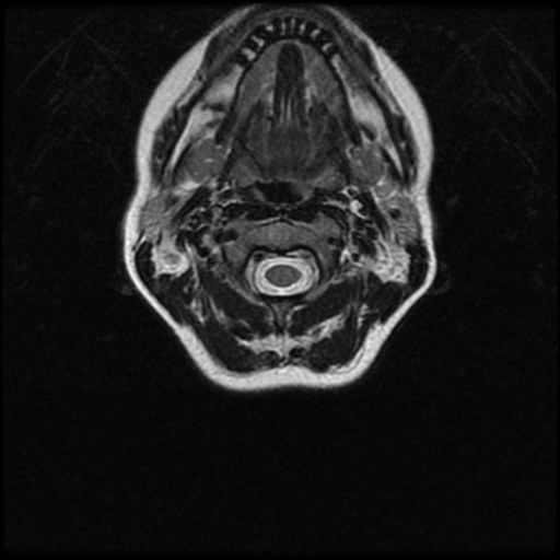 Cerebral autosomal dominant arteriopathy with subcortical infarcts and leukoencephalopathy (CADASIL) (Radiopaedia 41018-43763 Ax T2 C2-T1 30).png