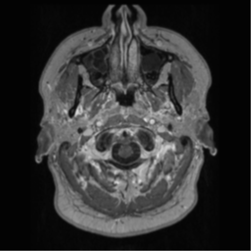 Cerebral cavernoma and development venous anomaly (Radiopaedia 37603-39482 Axial T1 C+ 5).png